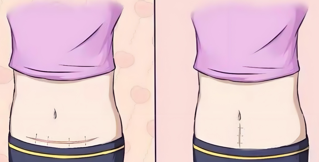 梁紅偉腹壁整形實例