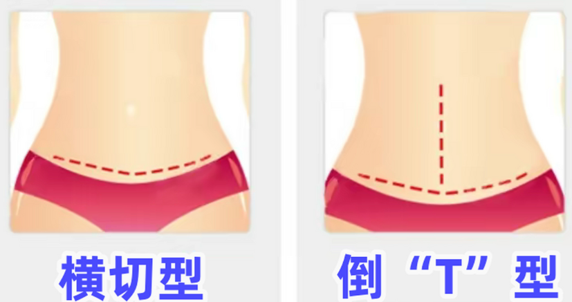 梁紅偉腹壁整形實例就診攻略