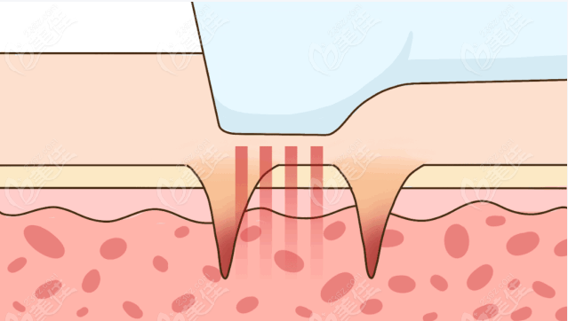 CO?點(diǎn)陣激光 CO?點(diǎn)陣激光
