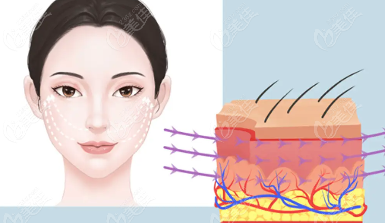 筋膜提升手術 筋膜提升手術