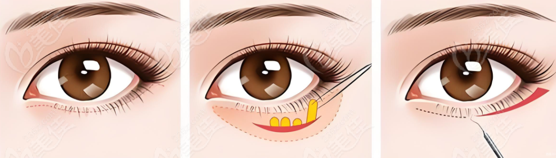 眼袋去除 眼袋去除