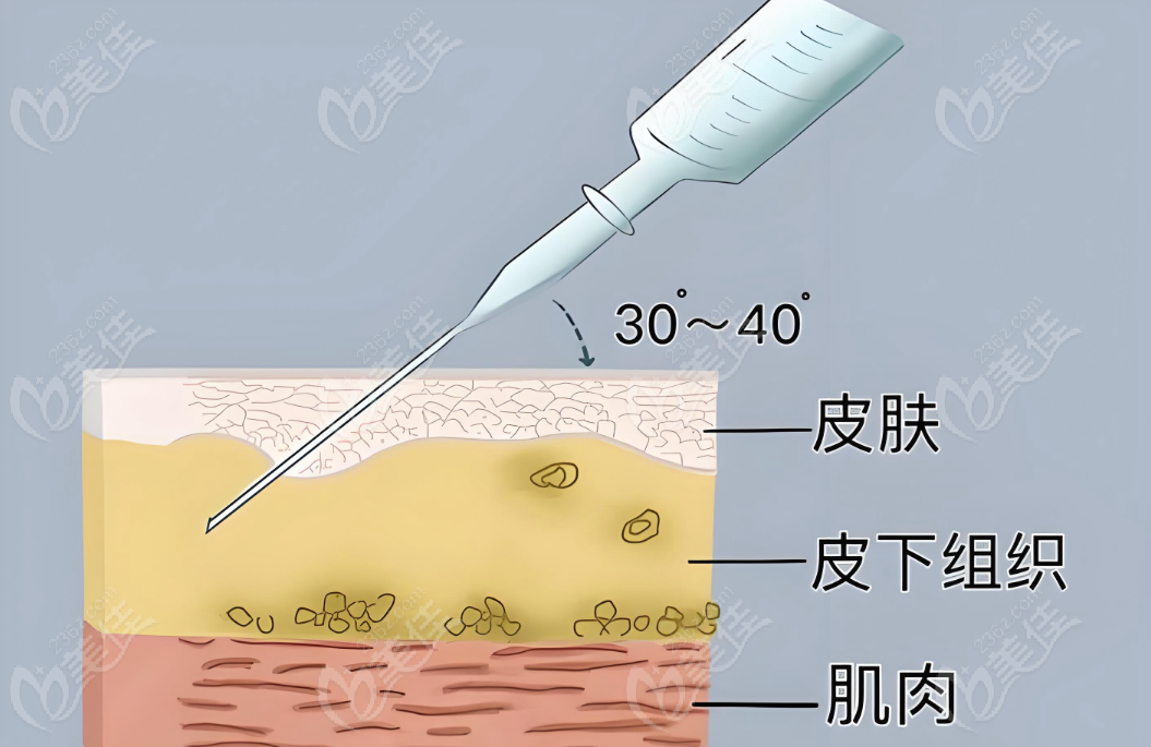 注射美容原理www.pfflawyer.com 注射美容原理www.pfflawyer.com