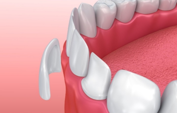 咸陽(yáng)牙齒貼片哪家醫(yī)院好www.pfflawyer.com