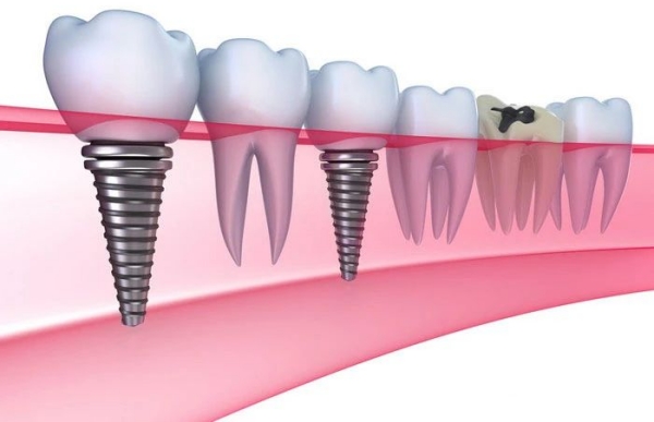 榆林德系口腔種植牙