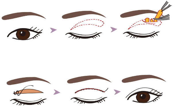 上海全切雙眼皮平價醫(yī)生哪個好