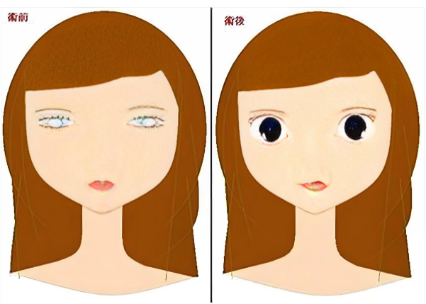 上海雙眼皮寬改窄修復(fù)好的醫(yī)生對比