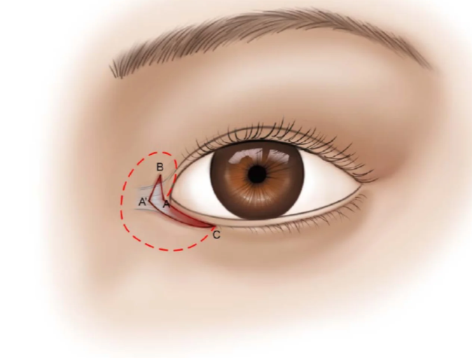 劉輔容皮瓣移植修復(fù)