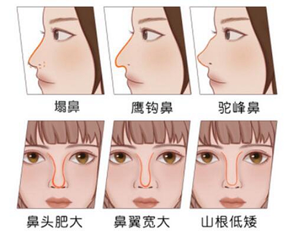 內(nèi)江隆鼻哪里可以做