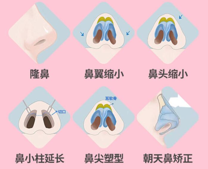 為啥同樣的項(xiàng)目?jī)?nèi)江價(jià)格差這么多？影響隆鼻價(jià)格的5個(gè)關(guān)鍵因素