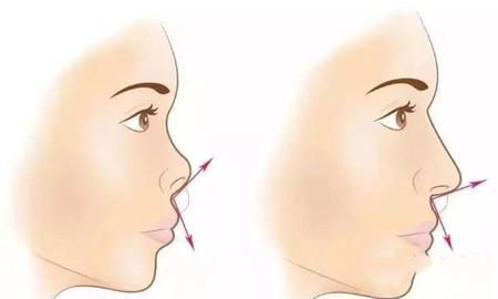 隆鼻術(shù)后注意事項(xiàng)：做好這些，變好較快還自然