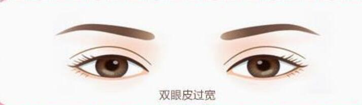 上海修復(fù)肉條雙眼皮哪里做的好？