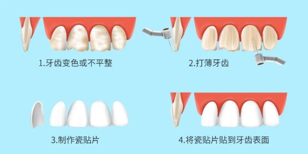 咸陽(yáng)牙齒貼面收費(fèi)透明度