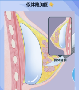 廣州可玉唐志榮醫(yī)生假體隆胸