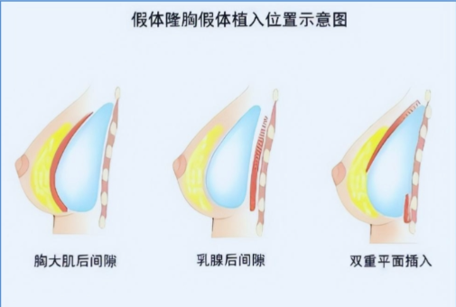 廣州可玉唐志榮醫(yī)生隆胸