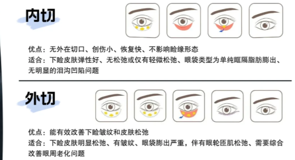 樂山達(dá)芬奇（軍大）祛眼袋手術(shù)類型