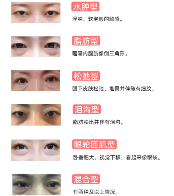 達芬奇的不開刀祛眼袋到底靠譜嗎？