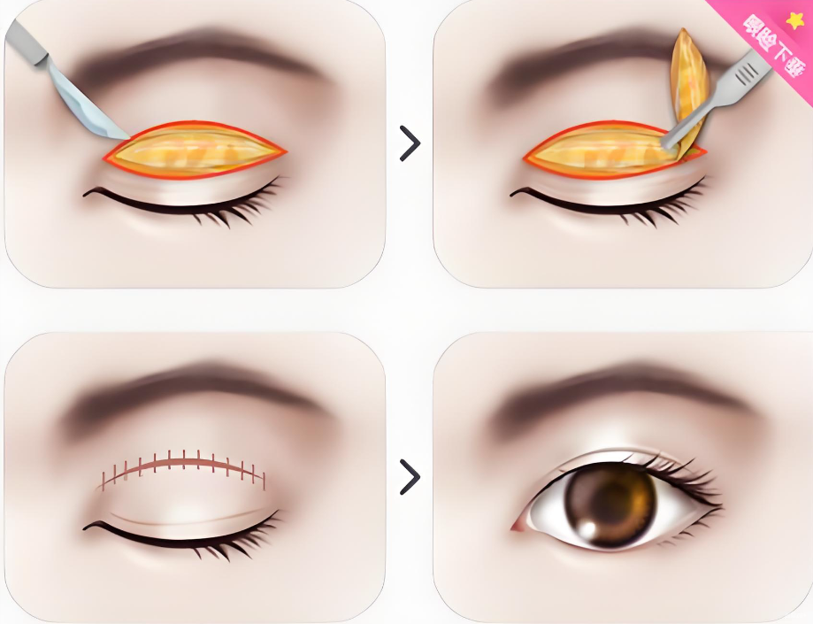 重慶割雙眼皮醫(yī)院