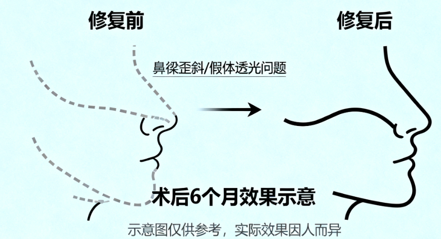 上海鼻修復(fù)