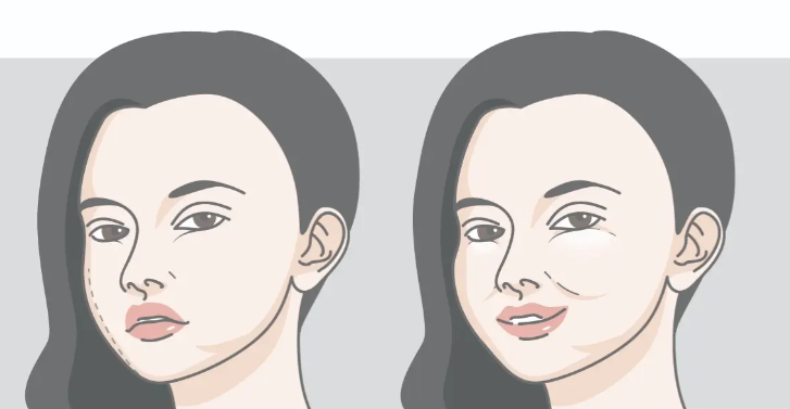 韓可旺SmileFace可視化取饅的療效顯著