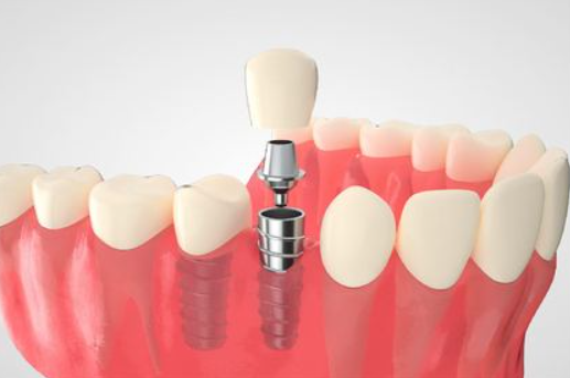 耒陽(yáng)種植牙哪家好又靠譜