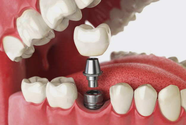 耒陽(yáng)種植牙哪家好又靠譜