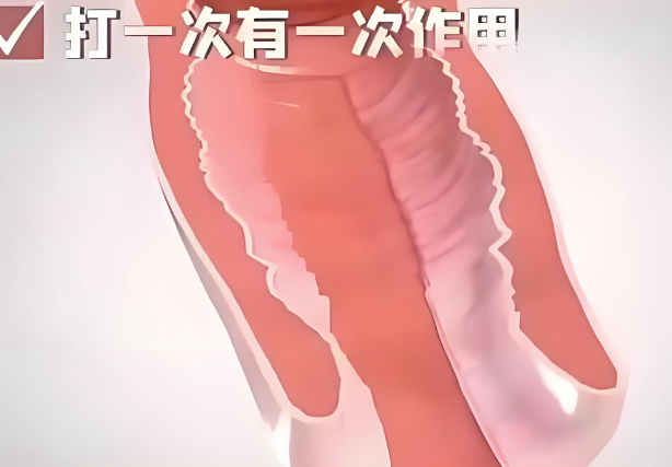 注射ADM緊縮針注射幾次？