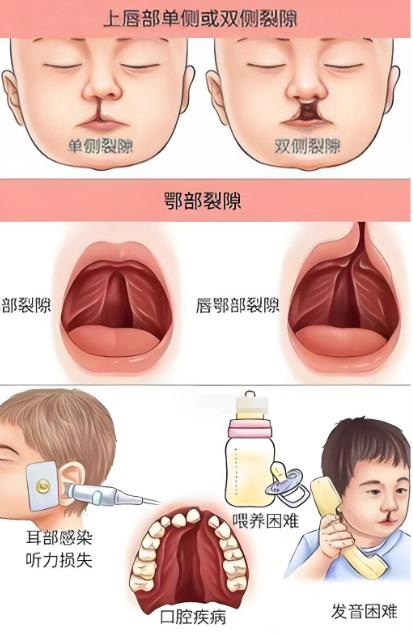 重慶唇腭裂手術(shù)