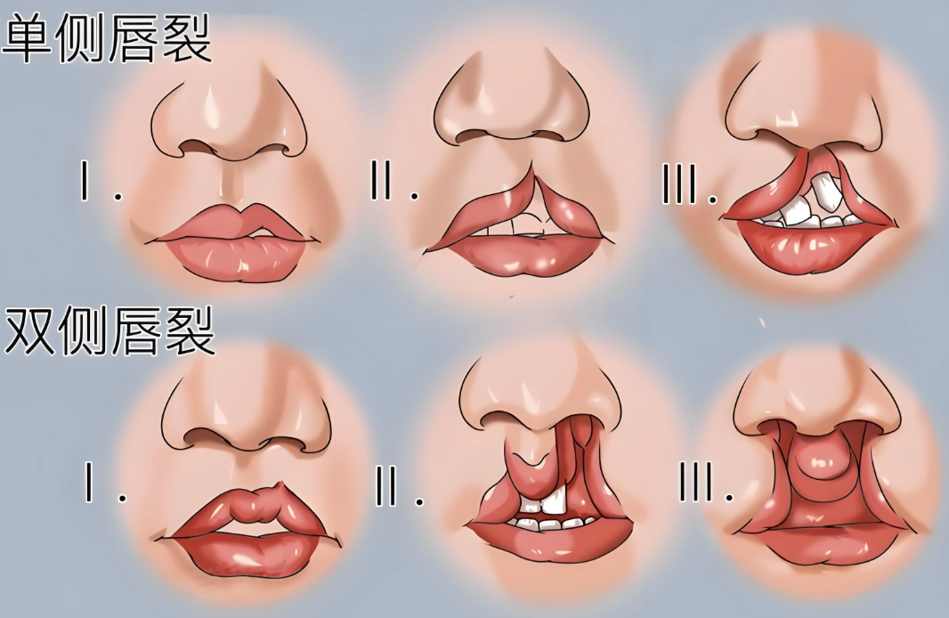 唇腭裂修復(fù)手術(shù)www.pfflawyer.com