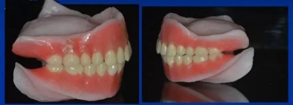 延安老人做全口吸附性義齒收費透明度