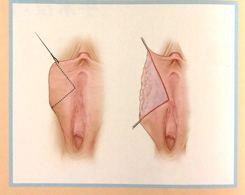 郝衛(wèi)潔醫(yī)生做私密手術(shù)真的很棒