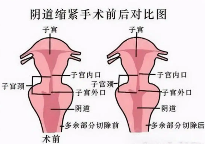 郝衛(wèi)潔醫(yī)生做私密手術(shù)真的很棒