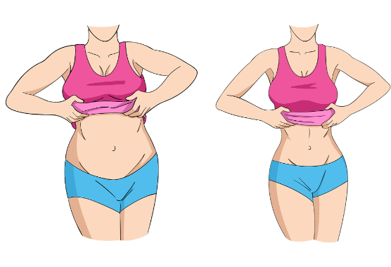 重庆长城医院杨志强腹壁成形实例成形好