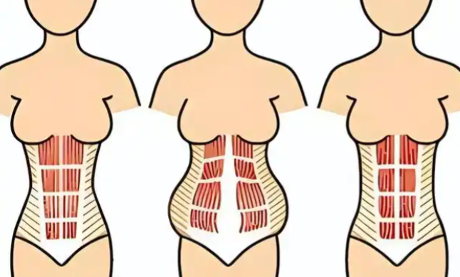 重庆长城医院杨志强医生腹壁成型做得好