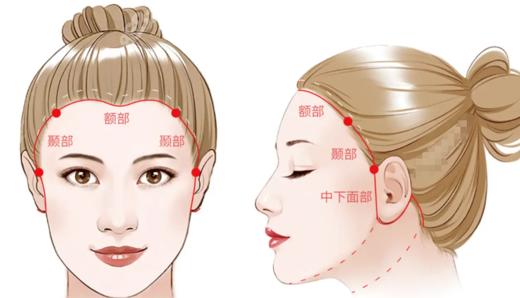 温志华拉皮手术实例及价格