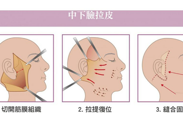 温志华拉皮手术实例及价格影响因素