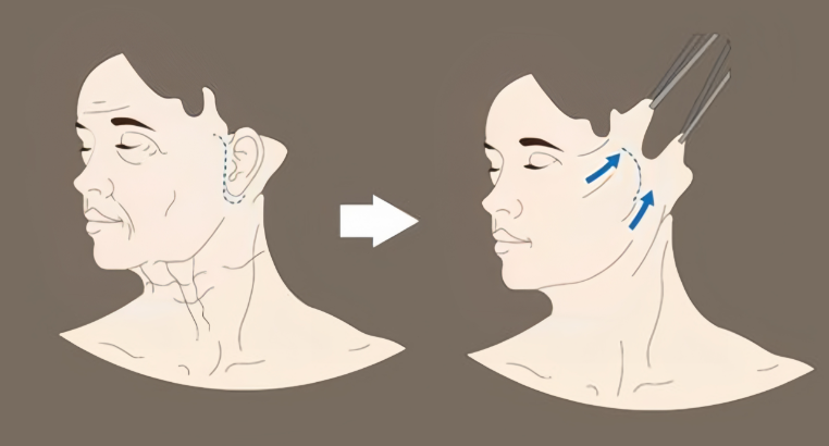 温志华拉皮手术实例分享