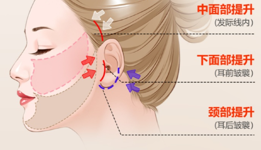 整形手术示例图