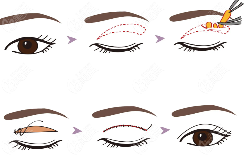 赵学燕双眼皮示意图 赵学燕双眼皮示意图