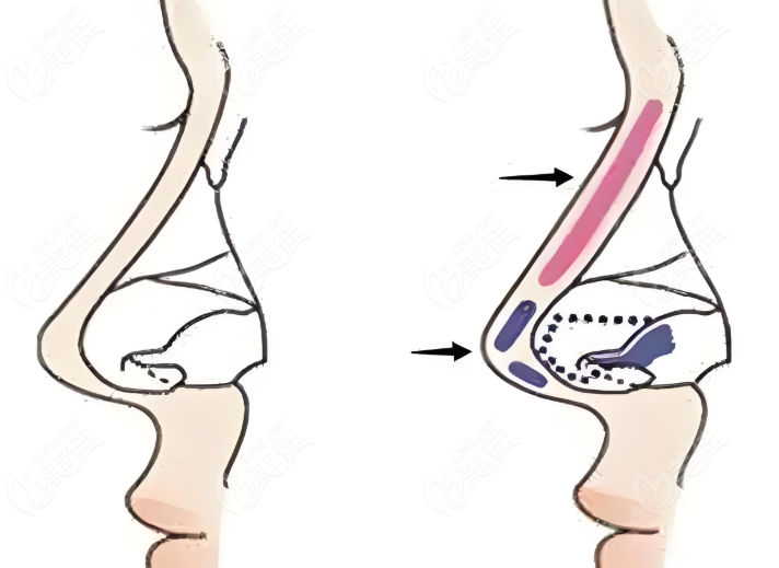 赵学燕隆鼻精细 赵学燕隆鼻精细