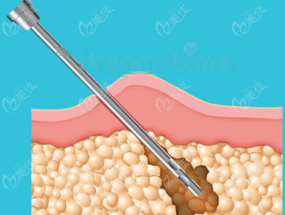 赵学燕吸脂示意图 赵学燕吸脂示意图