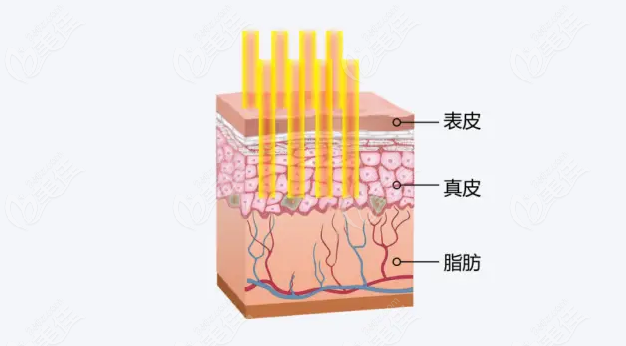 色素激光治疗示意图 色素激光治疗示意图