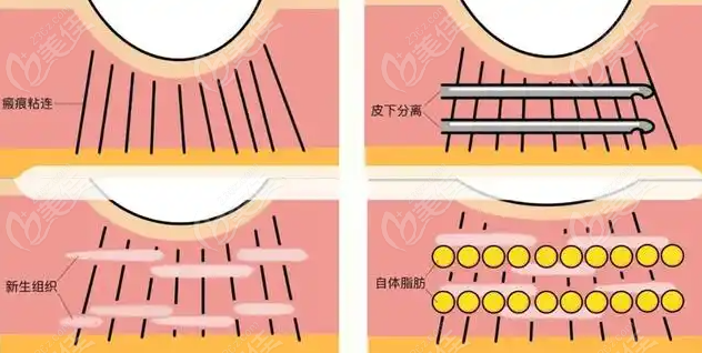 痤疮管理与瘢痕修复 痤疮管理与瘢痕修复
