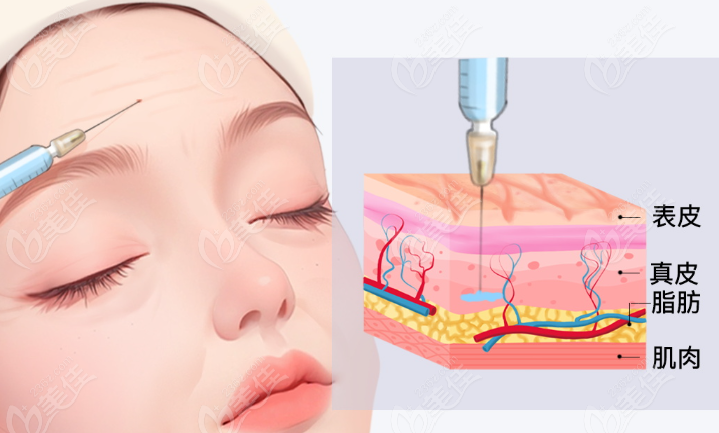 注射填充 注射填充