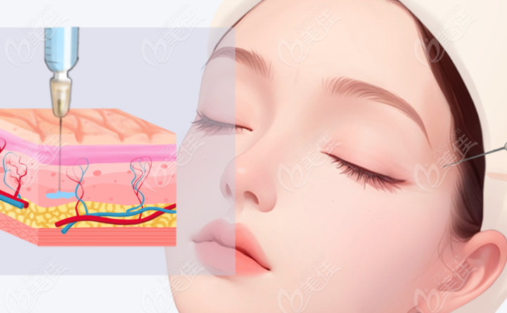 注射塑形 注射塑形