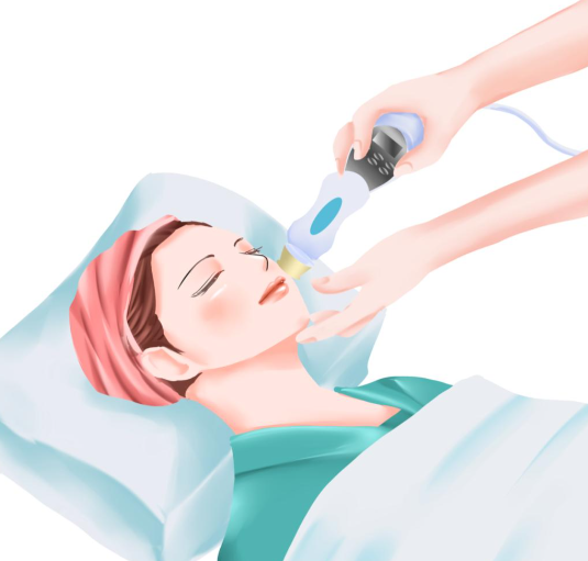 皮秒鐳射改善頸紋的費用及患者評價