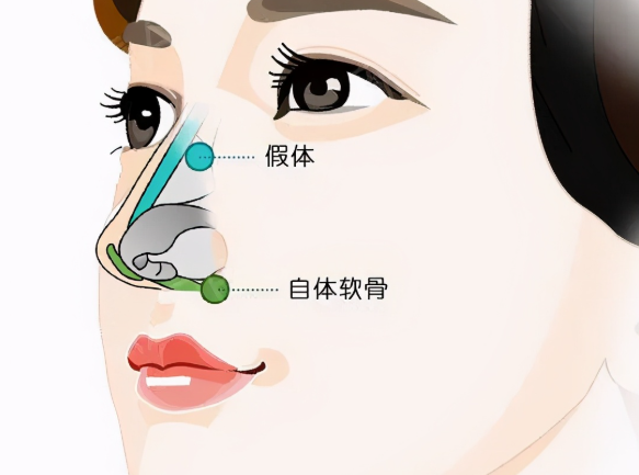 贵阳惺悦医疗美容医院鼻部整形价格