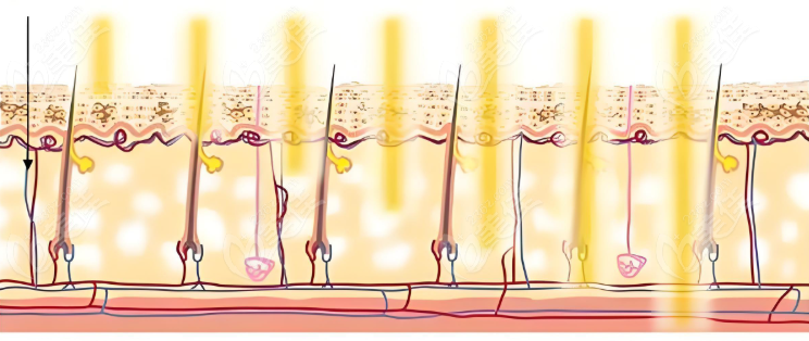 激光皮肤治疗示意图 激光皮肤治疗示意图