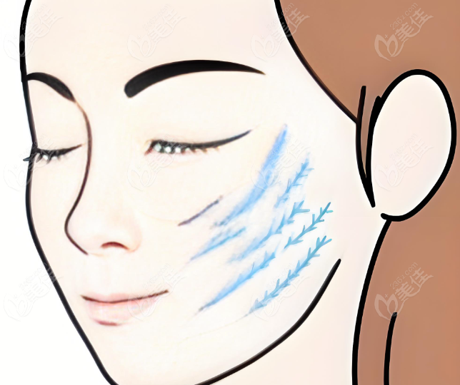 面部年轻化多维治疗 面部年轻化多维治疗