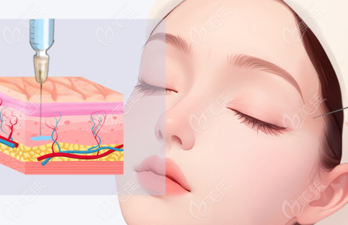 李想注射玻尿酸示意图 李想注射玻尿酸示意图