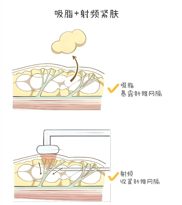重庆黄彪抽脂技术怎么样
